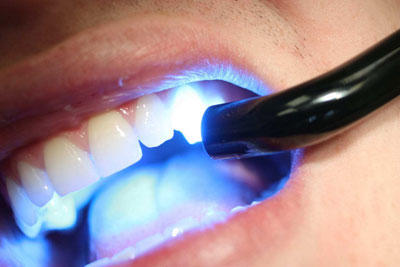 Безопасное лазерное отбеливание зубов
